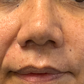 preservation-rhinoplasty-after